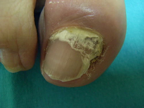 Los medios para el tratamiento del hongo de las uñas de la pastilla