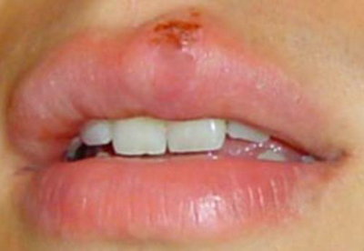 Remedios caseros para herpes Remedios caseros para herpes