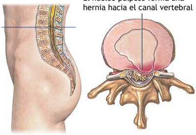Hernia discal, como aliviar síntomas Hernia discal, como aliviar síntomas