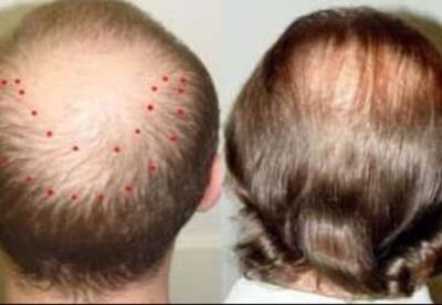 Mesoterapia capilar: Efecto secundario Mesoterapia capilar: Efecto secundario