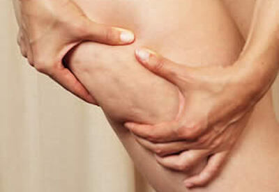 La celulitis y cómo combatirla La celulitis y cómo combatirla