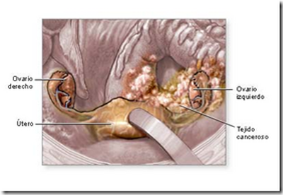 Cancer de Ovario, mejoran el diagnostico Cancer de Ovario, mejoran el diagnostico