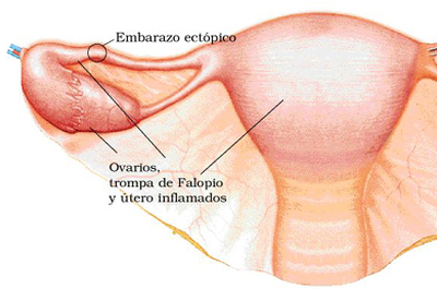 Embarazo ectópico Embarazo ectópico