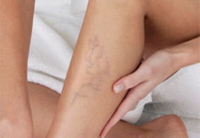 Varices Varices