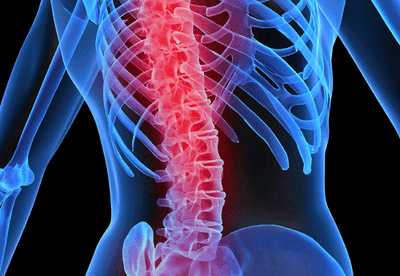 Osteoporosis, el mal de los huesos frágiles que casi nadie cree padecer Osteoporosis, el mal de los huesos frágiles que casi nadie cree padecer