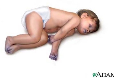 Cianosis del bebe: causas, tipos, sintomas y tratamientos Cianosis del bebe: causas, tipos, sintomas y tratamientos