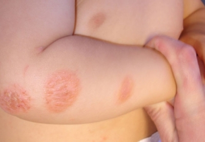 6 remedios fáciles para tratar el eczema 6 remedios fáciles para tratar el eczema