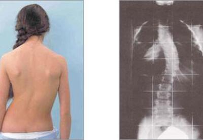 Ejercicios para la escoliosis Ejercicios para la escoliosis