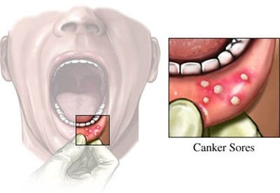 Estomatitis aftosa Estomatitis aftosa