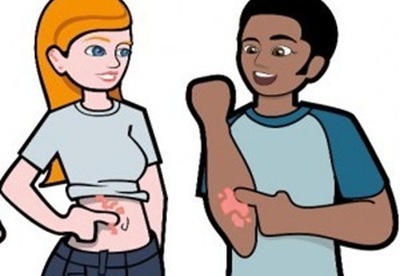 Enfermedades de la piel | Psoriasis Enfermedades de la piel | Psoriasis