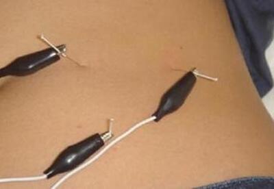 Acupuntura abdominal Acupuntura abdominal