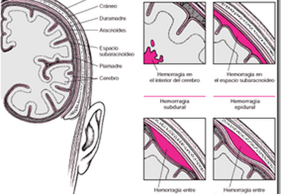 Hemorragia intracraneal| Estudian una inyeccion que podria evitar muchas muertes Hemorragia intracraneal| Estudian una inyeccion que podria evitar muchas muertes