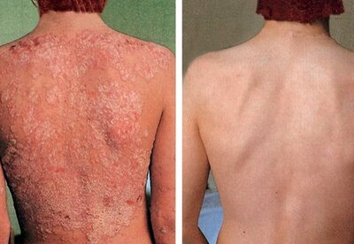 Acerca de la Psoriasis, enfermedad sin cura Acerca de la Psoriasis, enfermedad sin cura