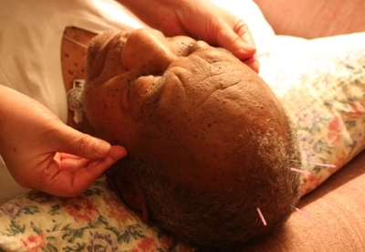 Acupuntura: tratamiento para la pérdida de cabello Acupuntura: tratamiento para la pérdida de cabello