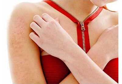 Alimentación para controlar la dermatitis Alimentación para controlar la dermatitis