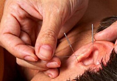 Auriculoterapia para dejar de fumar Auriculoterapia para dejar de fumar