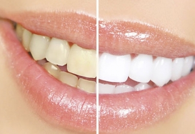¿Cómo librarse de las manchas dentales? ¿Cómo librarse de las manchas dentales?