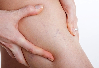 Como desaparecer las varices Como desaparecer las varices