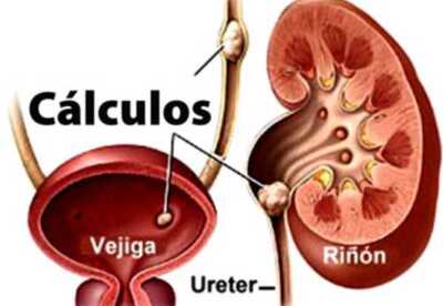 Como disolver los cálculos renales naturalmente Como disolver los cálculos renales naturalmente