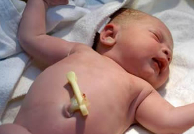 Cordon umbilical bebé recien nacido Cordon umbilical bebé recien nacido