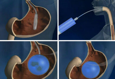 ¿Cuánto se adelgaza con el balón intragastrico? ¿Cuánto se adelgaza con el balón intragastrico?