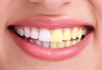 Dientes amarillos como blanquearlos sin riesgos Dientes amarillos como blanquearlos sin riesgos