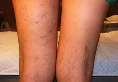 Ejercicios para prevenir varices y otros tratamientos Ejercicios para prevenir varices y otros tratamientos