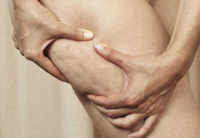 Eliminar celulitis con cafeína tratamiento natural Eliminar celulitis con cafeína tratamiento natural