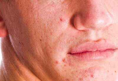 Lavado facial para el acné y rosácea según nuestra piel Lavado facial para el acné y rosácea según nuestra piel