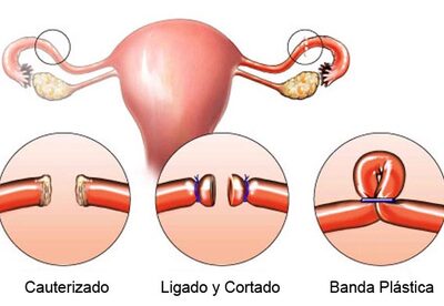 Ligadura de trompas ventajas y desventajas Ligadura de trompas ventajas y desventajas