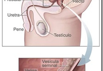 La Resonancia Magnetica y el cancer de prostata, una herramienta no invasiva La Resonancia Magnetica y el cancer de prostata, una herramienta no invasiva