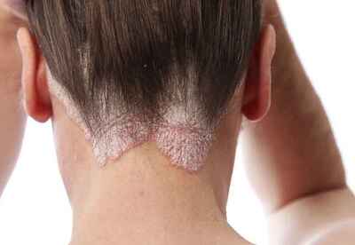 Psoriasis en el cuero cabelludo causas y tipos de tratamientos Psoriasis en el cuero cabelludo causas y tipos de tratamientos