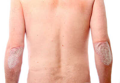 Psoriasis síntomas, causas y tratamientos Psoriasis síntomas, causas y tratamientos