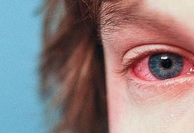 Remedios caseros para eliminar los ojos rojos Remedios caseros para eliminar los ojos rojos