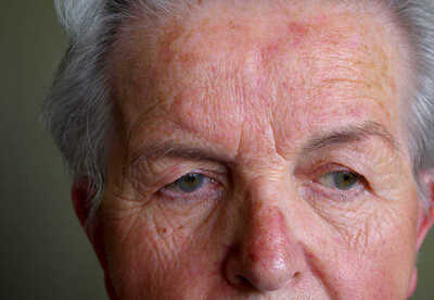 Rosacea tratamiento natural en casa Rosacea tratamiento natural en casa
