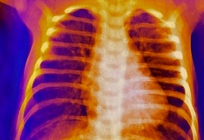 Sindrome de Tietze Sindrome de Tietze