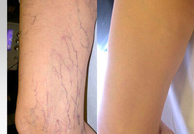 Tratamiento para las várices en las piernas Tratamiento para las várices en las piernas