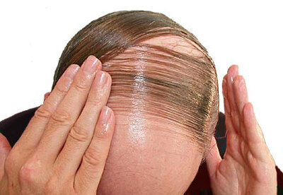 Tratamientos contra la alopecia Tratamientos contra la alopecia