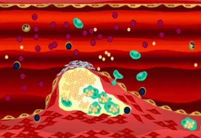 Niveles altos de Colesterol pueden desarrollar Arterioesclerosis Niveles altos de Colesterol pueden desarrollar Arterioesclerosis