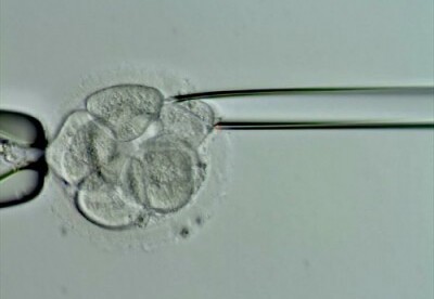 Biopsia de endometrio Biopsia de endometrio