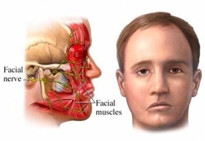 Paralisis facial Paralisis facial