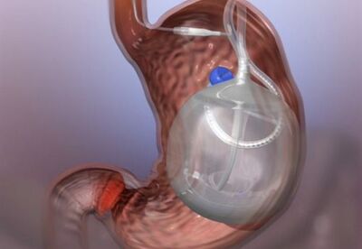 Peligros y riesgos del balón intragastrico Peligros y riesgos del balón intragastrico