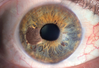 Nuevos tratamientos del cáncer de ojo Nuevos tratamientos del cáncer de ojo