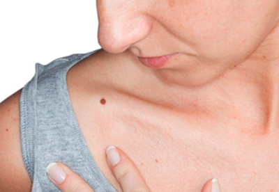 El cáncer de piel se cura si se diagnostica a tiempo. Revisa tus lunares El cáncer de piel se cura si se diagnostica a tiempo. Revisa tus lunares