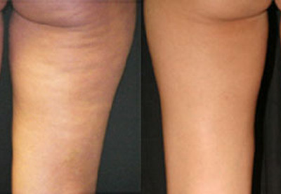 Trucos para evitar la celulitis Trucos para evitar la celulitis