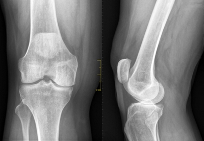 Cómo ayudar a reparar los cartílagos Cómo ayudar a reparar los cartílagos