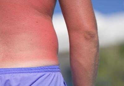 El peligro de los rayos del sol El peligro de los rayos del sol