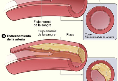 Novedoso estudio para medir la edad real de las arterias Novedoso estudio para medir la edad real de las arterias