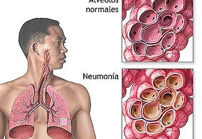 Neumonia| informacion, video Neumonia| informacion, video