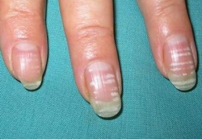 Leuconiquia: manchas blancas en las uñas Leuconiquia: manchas blancas en las uñas